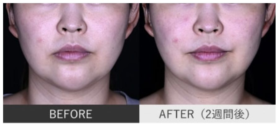 口角ボトックスのおすすめクリニック10選 デメリットや効果は ダウンタイム 値段相場も解説 Skinlife