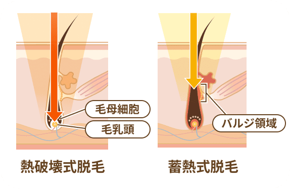 熱破壊式脱毛 蓄熱式脱毛