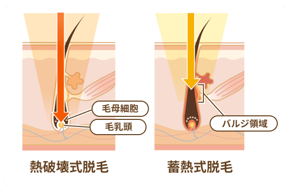 熱破壊式脱毛 蓄熱式脱毛